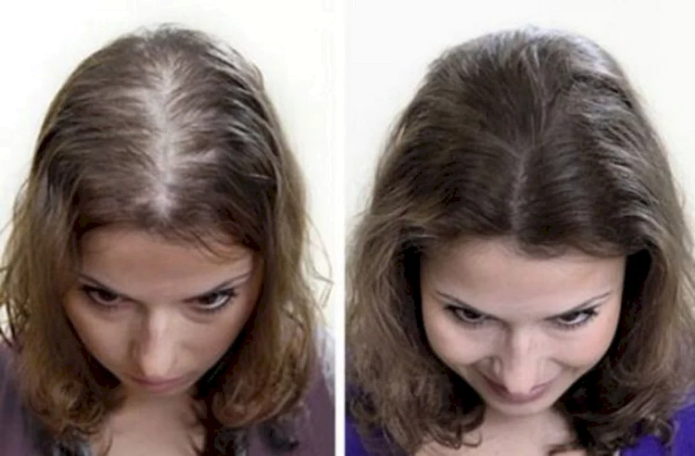 Before after loss hair girl