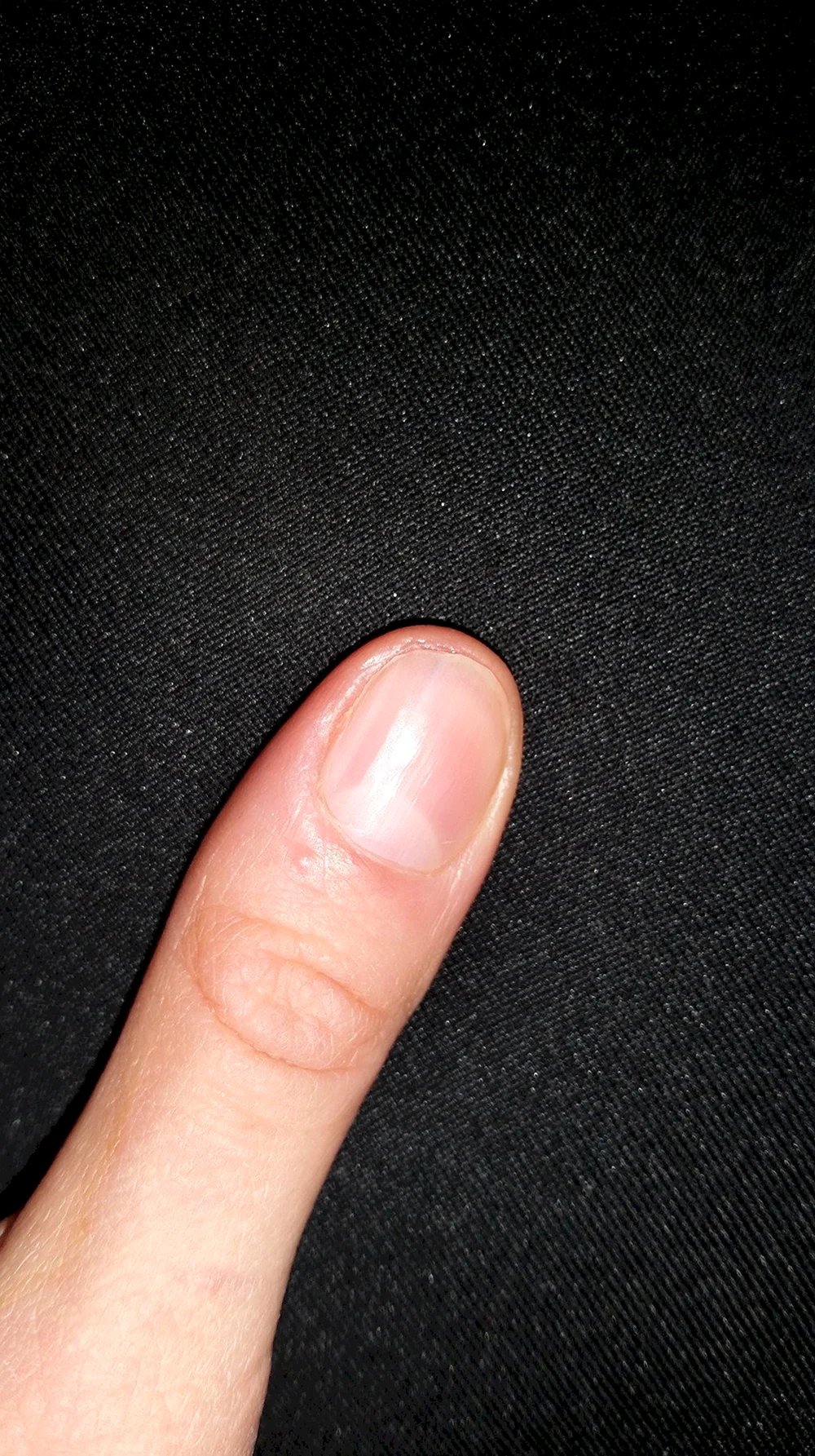 Чёрная полоса на ногте пальца