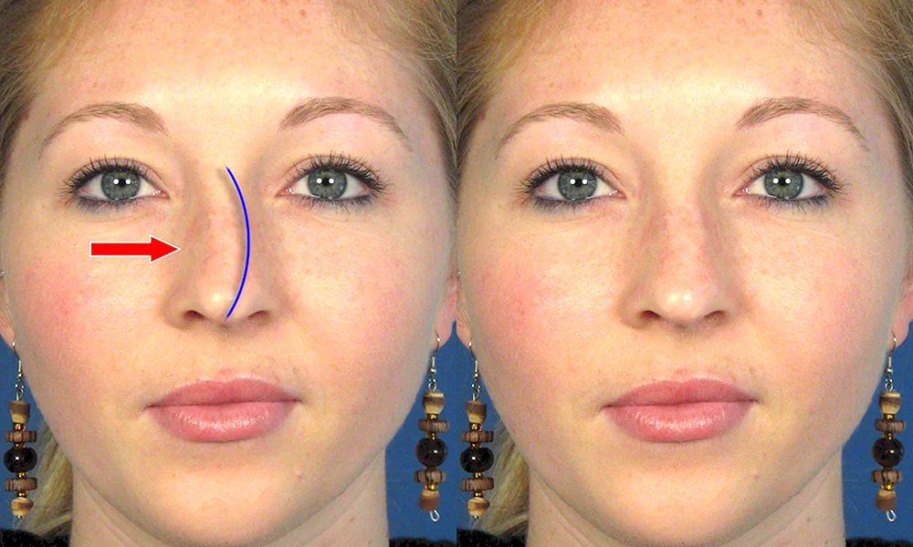 Crooked nose after Rhinoplasty