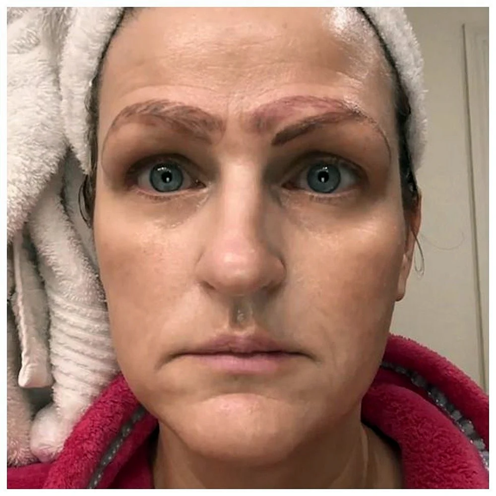 Eyebrow transplant women