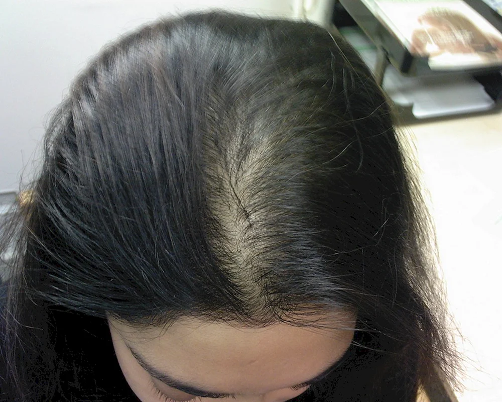 Female hair loss