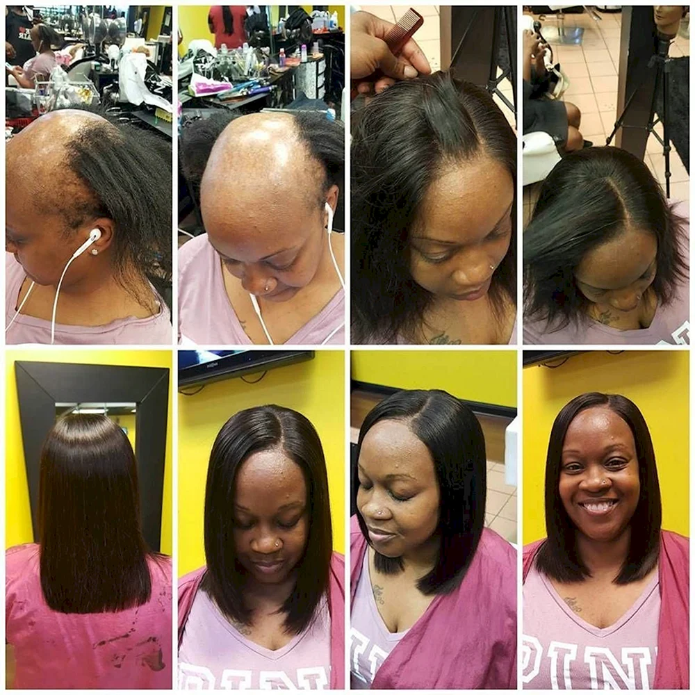 Hair loss Black women