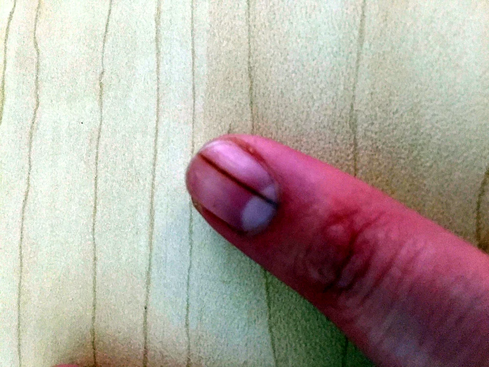 Коричневые полоски на ногтях