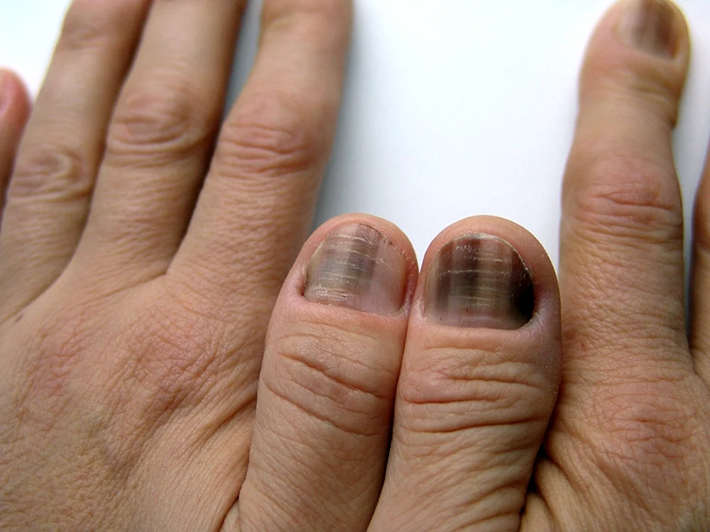 Негрибковые заболевания ногтей