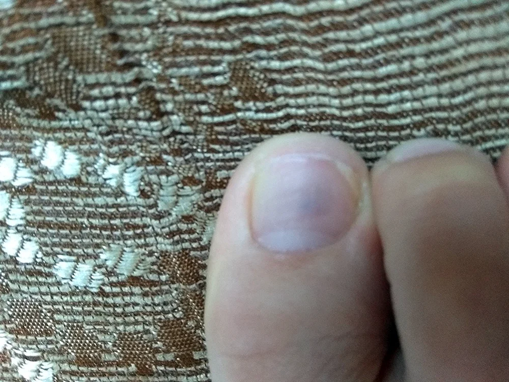 Пятно на ногте большого пальца ноги