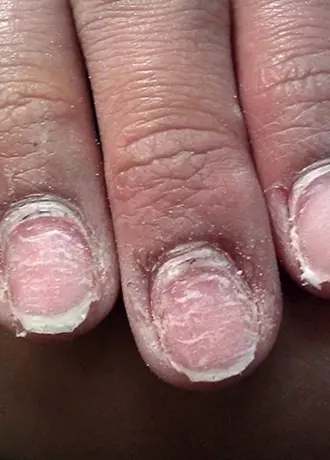 Последствия наращивания ногтей