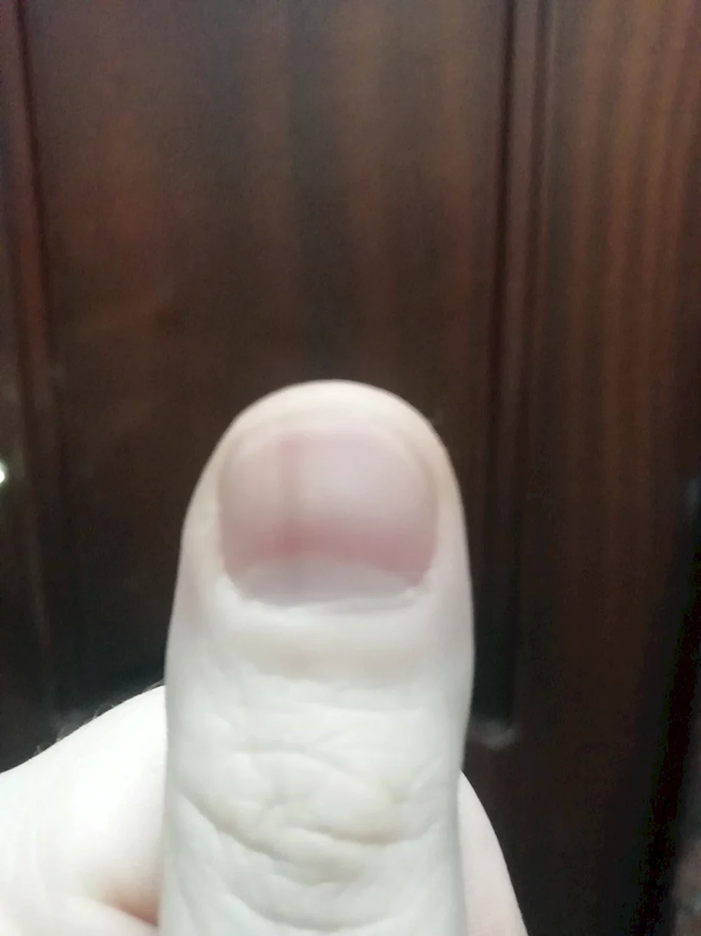 Продольная полоска на ногте большого пальца