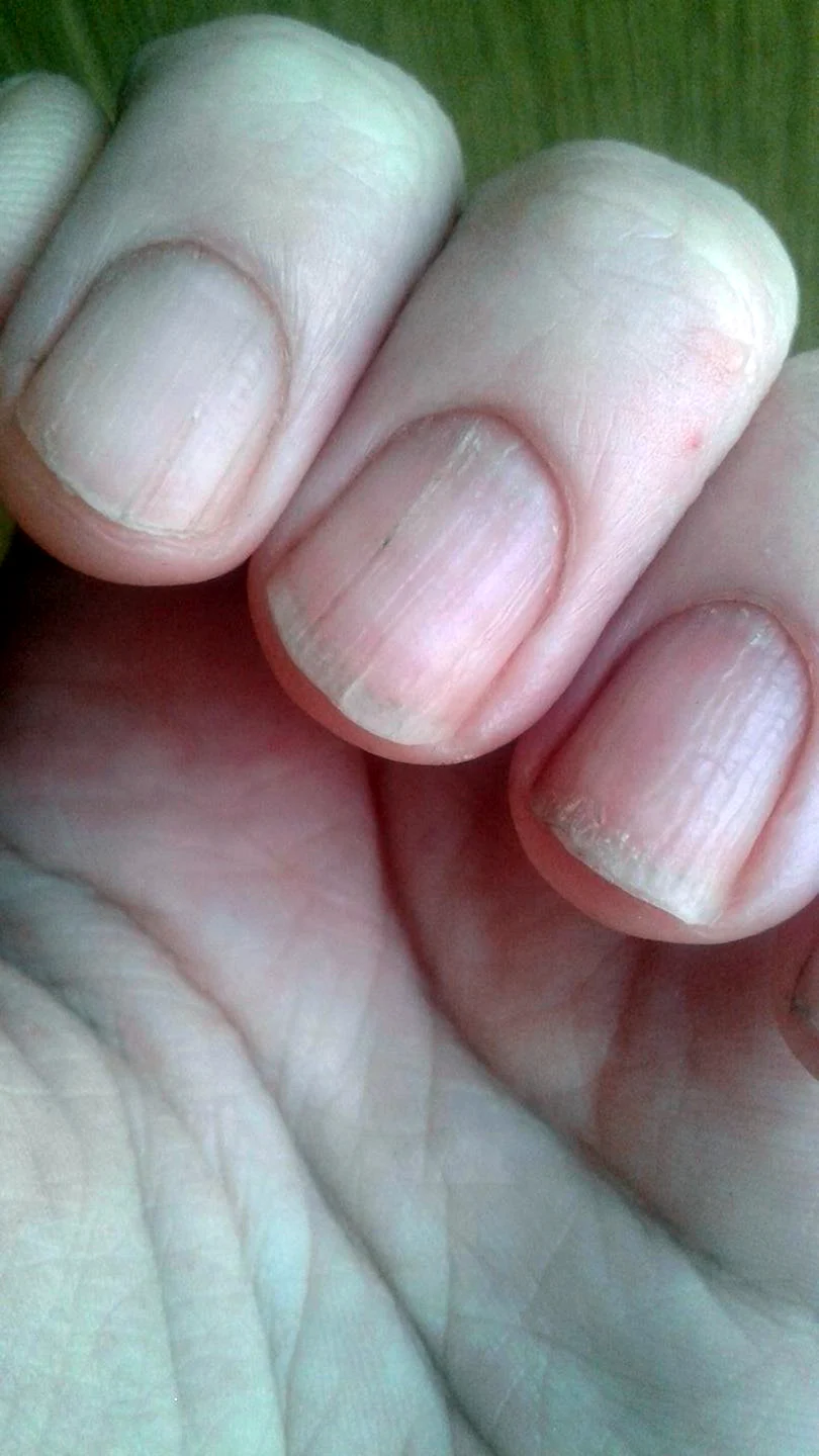 Темные пятнышки на ногтях рук