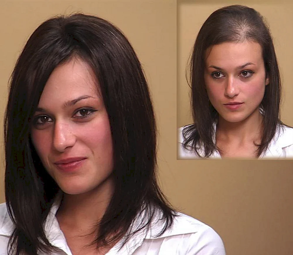 Woman hair growth before after