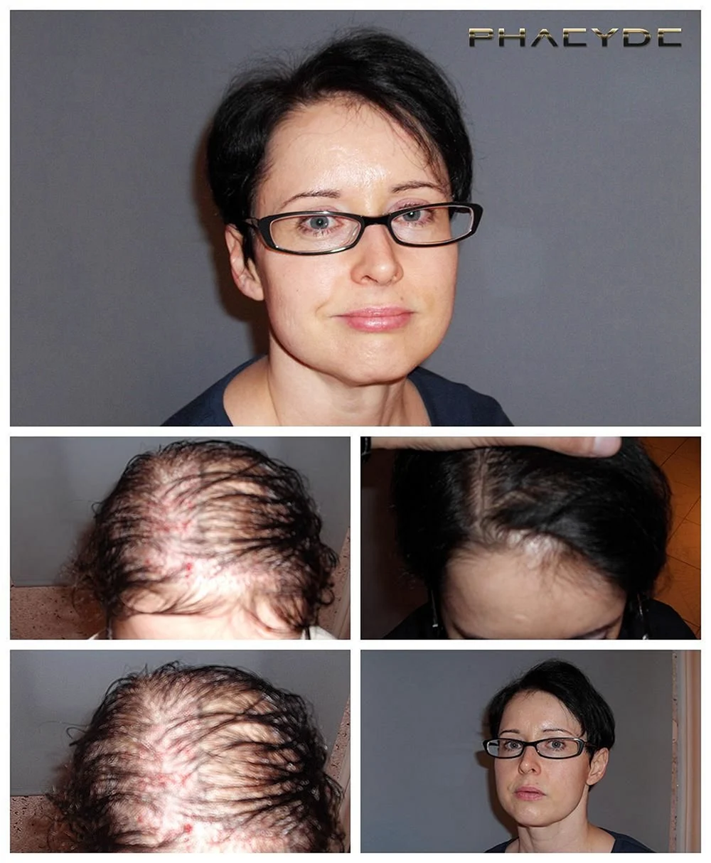 Women hair Restoration before after