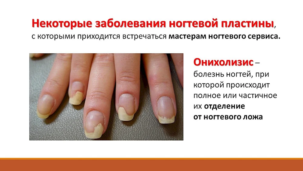 Заболевания ногтей на руках таблица